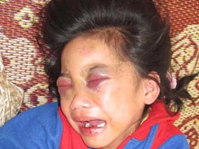 Kiến nghị tước quyền bố mẹ của vợ chồng đánh con nuôi