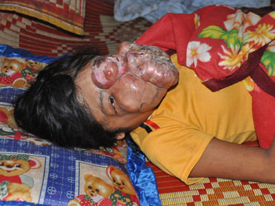 H’Loai với khuôn mặt dị dạng vì khối u