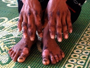 Thêm 2 ca tử vong do viêm da dày sừng bàn tay