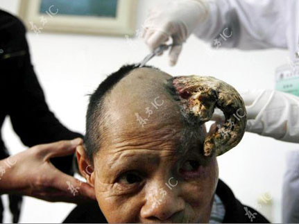 Một phụ nữ mọc sừng tại Trung Quốc