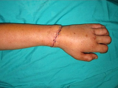 Nối thành công cẳng tay bị chém đứt lìa