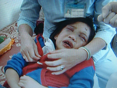 Bé gái 10 tuổi bị cha mẹ nuôi bạo hành dã man