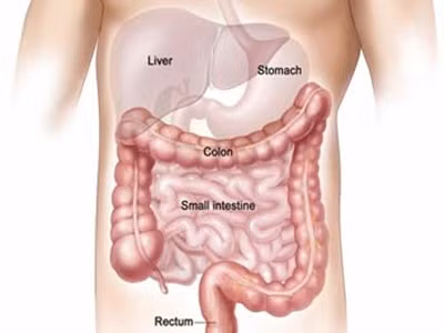 Phòng ngừa ung thư đại trực tràng