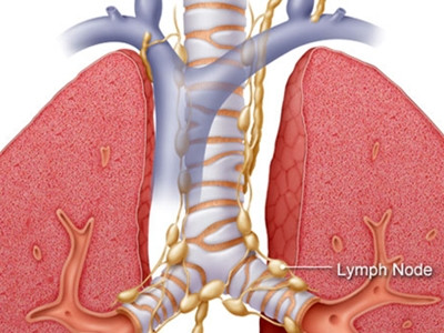 Nguy cơ và dấu hiệu của ung thư phổi
