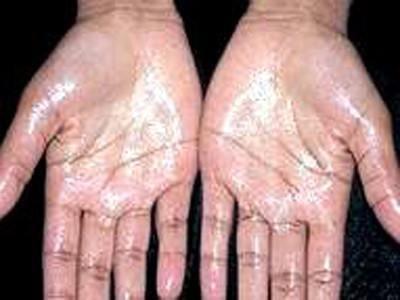 Có thể trị dứt điểm bệnh ra nhiều mồ hôi