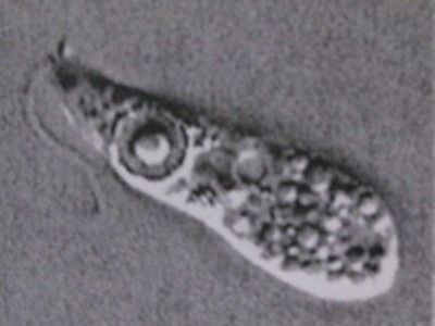 Amip ăn não người bị nghi giết chết một em bé