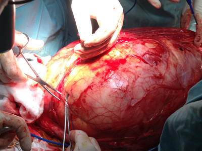 Bóc khối u gần 13kg từ chân bệnh nhân