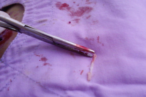 Mê ăn gỏi cá sống, một phụ nữ có sán... ở đùi