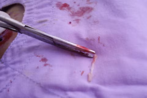 Mê ăn gỏi cá sống, một phụ nữ có sán... ở đùi