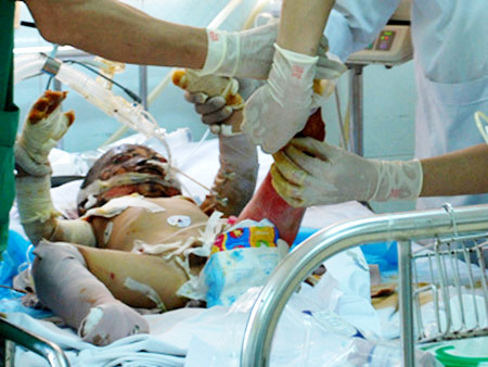 Bé ba tuổi bị đốt phải đắp da lợn lên vết thương