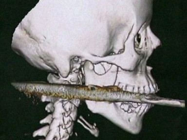 Bị lao đâm xuyên cuống họng vẫn sống sót