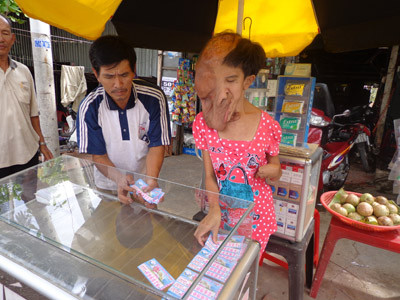 Cô gái hơn 2 thập kỷ sống với mũi, tai, miệng... chảy dài xuống ngực