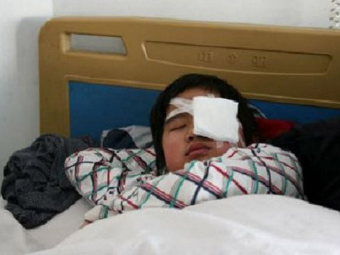 Em Dou sau khi phẫu thuật mắt vì giáo viên sai bạn tát 40 cái vào mặt