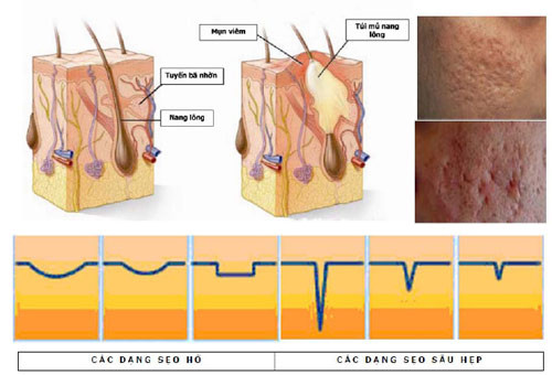 Nguyên nhân gây viêm nang lông