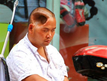 Phi thường người đàn ông sống với lỗ hổng trên đầu