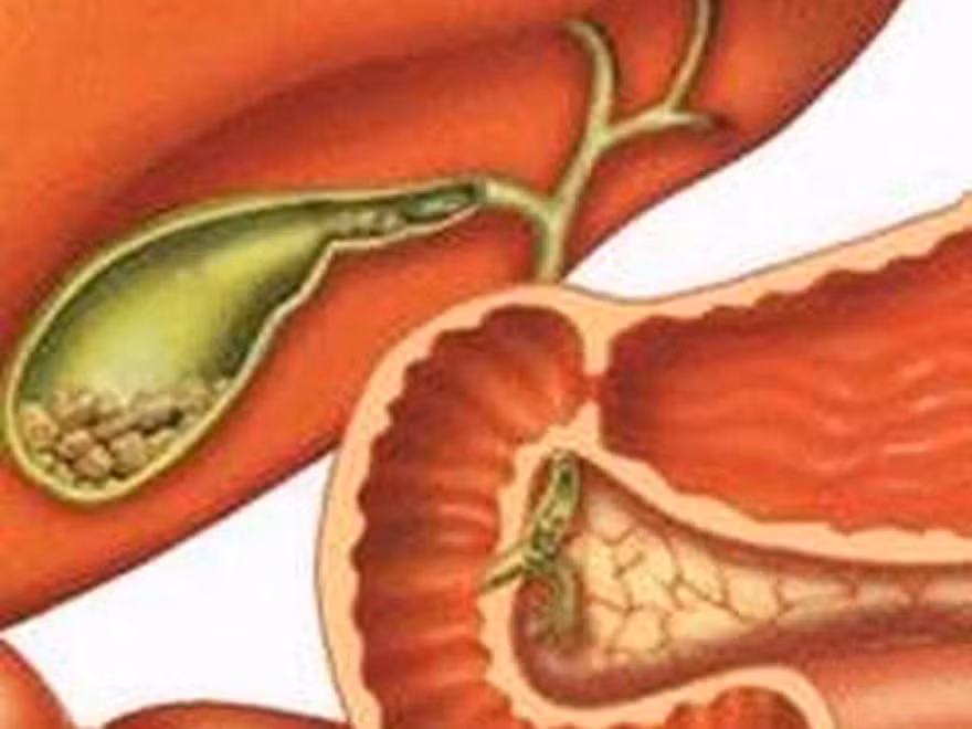 4 cách đơn giản phòng bệnh sỏi mật