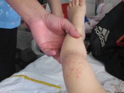 Những điều cần biết về Enterovirus 71