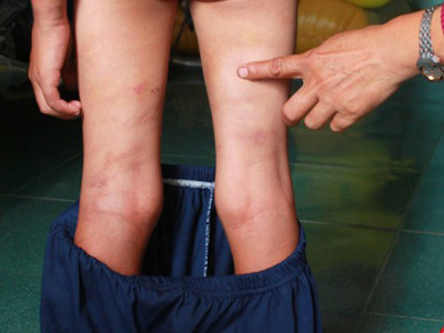 Cháu bé mười tuổi bị mẹ kế bạo hành