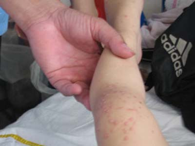 Thêm hai trẻ tử vong, vẫn chưa công bố dịch