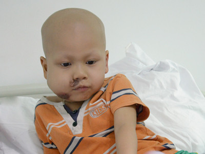 Cháu bé bị u mũi cần giúp đỡ