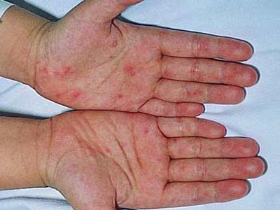 Đề phòng bệnh chân tay miệng biến chứng