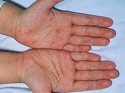 Số ca tay chân miệng tăng 4,4 lần