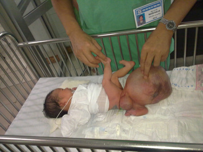 Đại phẫu cắt u quái hơn 2 kg cho trẻ một tuần tuổi