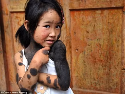 Bệnh ‘lông lá’ tấn công bé gái 6 tuổi