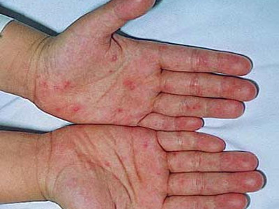 Bệnh chân tay miệng lại vào mùa