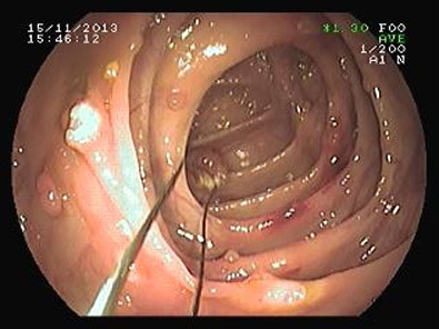 Nội soi cắt gần 40 u lành ở ruột già