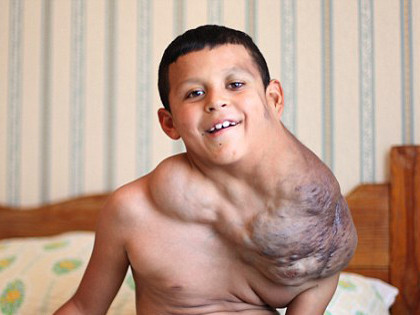 Bé trai 10 tuổi dùng Viagra trị u cổ