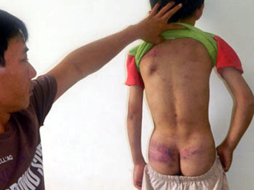 Cha bị bắt vì đánh con chín tuổi nhập viện