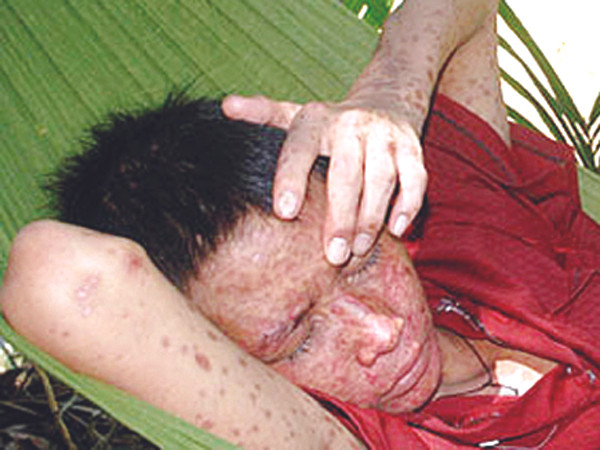 Bệnh 'lạ': Bộ Y tế vẫn một mình một chợ