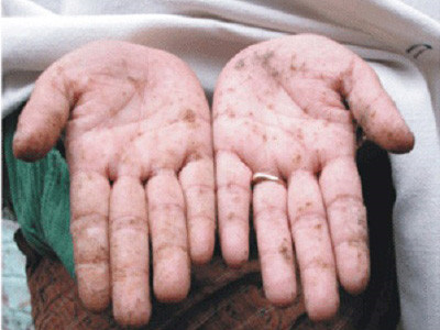 Biểu hiện của nhiễm độc asen