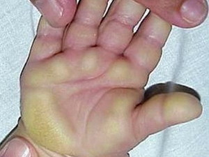 Chưa tìm ra độc chất gây 'bệnh lạ' tại Quảng Ngãi