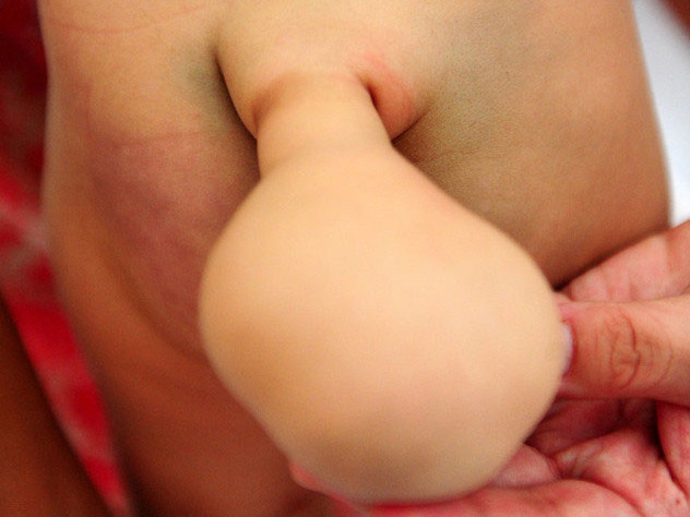 Kỳ lạ bé trai 7 tháng tuổi mọc đuôi