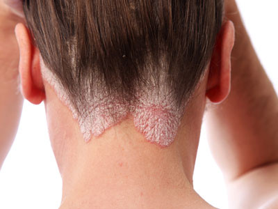 Khám và tư vấn sức khỏe miễn phí cho bệnh nhân vẩy nến