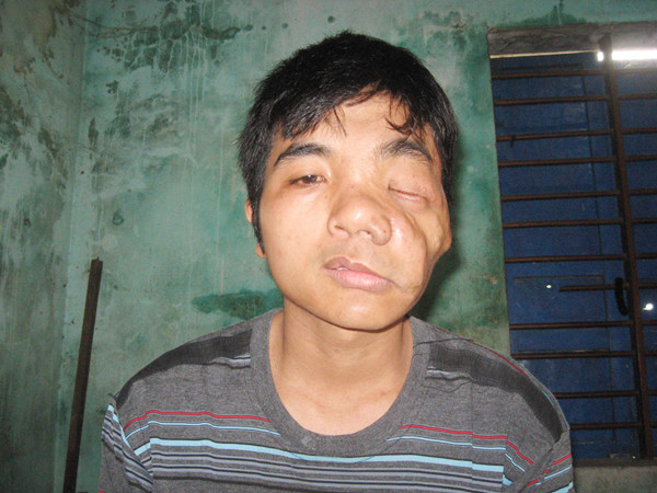 Khuôn mặt Tiến ngày càng biến dạng