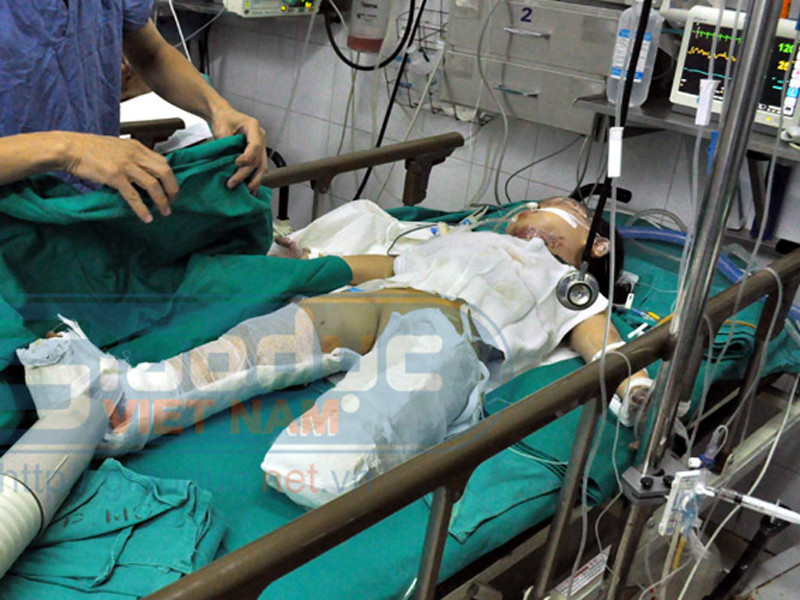 Sức khỏe cháu bé vụ nổ xe máy tiến triển tốt hơn