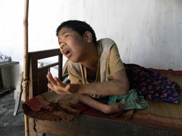 Cô gái bại não 28 năm nằm một chỗ