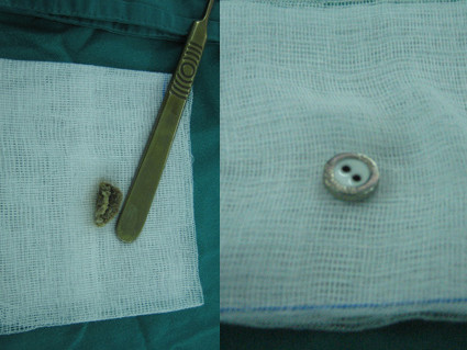 Nghịch dại, nhiều trẻ nhét đủ thứ đồ vào "vùng kín"