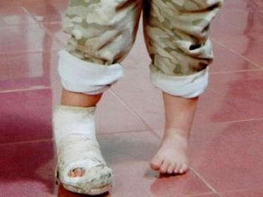 Thấy con quấy khóc không chịu ăn cớm, người bố vơ que tre dài cỡ 60 cm thẳng tay đánh gãy chân con trai mới 2 tuổi