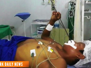 Bị xiên cá bắn vào đầu 4 ngày vẫn sống