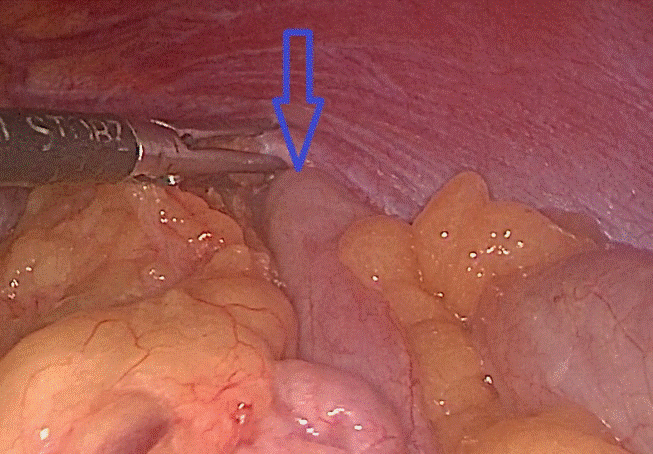 Đại tràng chui qua lỗ thoát vị lên trên ngực trái. Ảnh: BS cung cấp