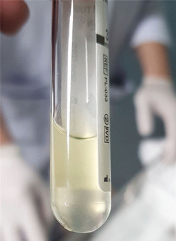 Dịch não tủy đục màu và hình ảnh gram âm dạng hạt cà phê đặc trưng của Neisseria meningitidis