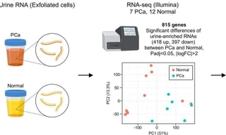 Nước tiểu có thể xác định chính xác ung thư tuyến tiền liệt