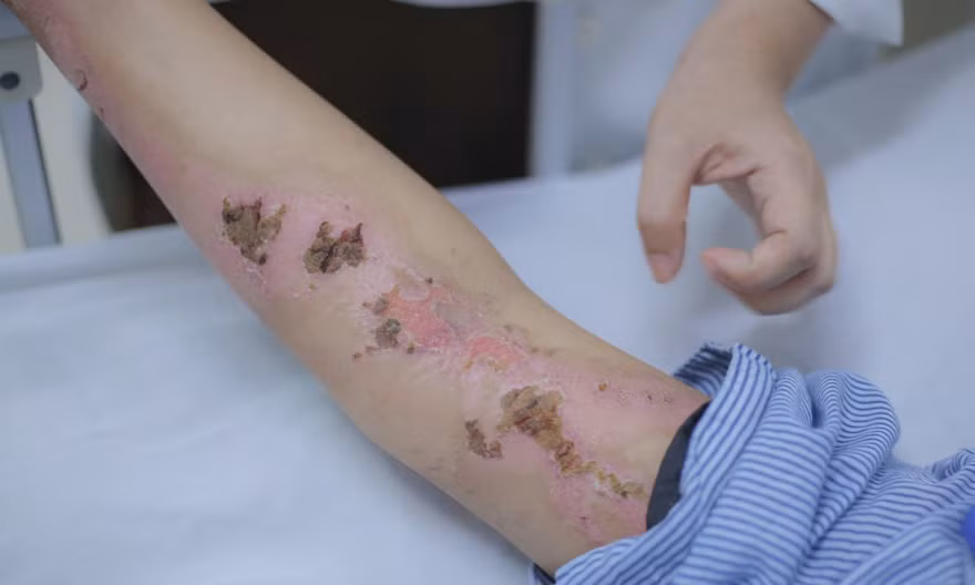 Cô gái gục xuống giữa cánh đồng sau cú sét đánh