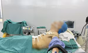 Phẫu thuật ung thư dạ dày cho bệnh nhân trong tư thế hiếm gặp