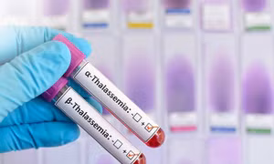 Đừng để trẻ sinh ra phải truyền máu suốt đời: Thalassemia có thể phòng ngừa