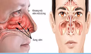 Đừng nhầm viêm mũi dị ứng với viêm xoang: Tự dùng thuốc có thể khiến bệnh nặng hơn